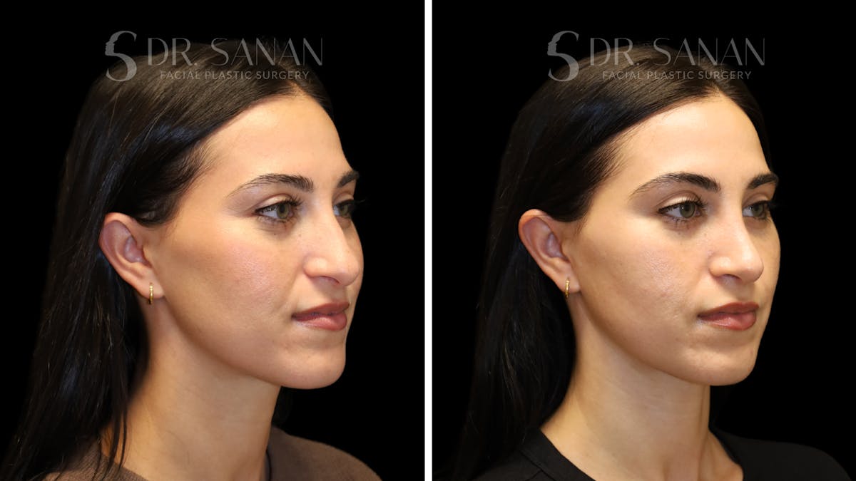 Rhinoplasty Before & After Gallery - Patient 712700 - Image 3