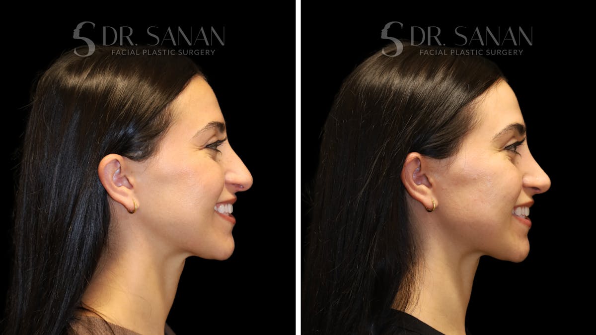 Rhinoplasty Before & After Gallery - Patient 712700 - Image 1