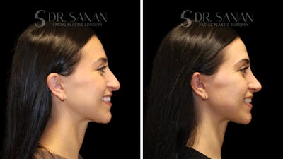 Rhinoplasty Before & After Gallery - Patient 712700 - Image 1