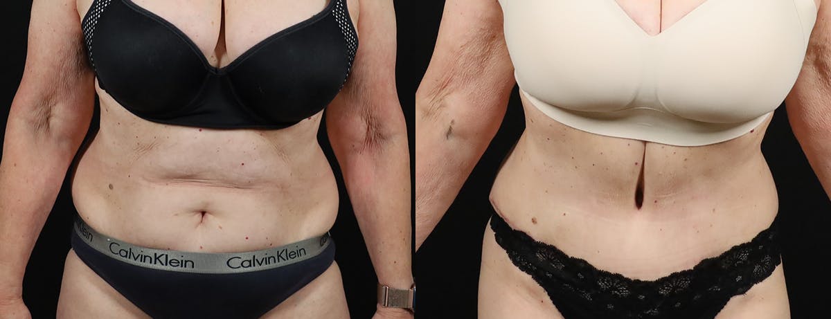 Abdominoplasty (Tummy Tuck) Before & After Gallery - Patient 217134 - Image 1