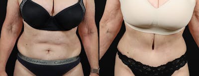 Abdominoplasty (Tummy Tuck) Before & After Gallery - Patient 217134 - Image 1