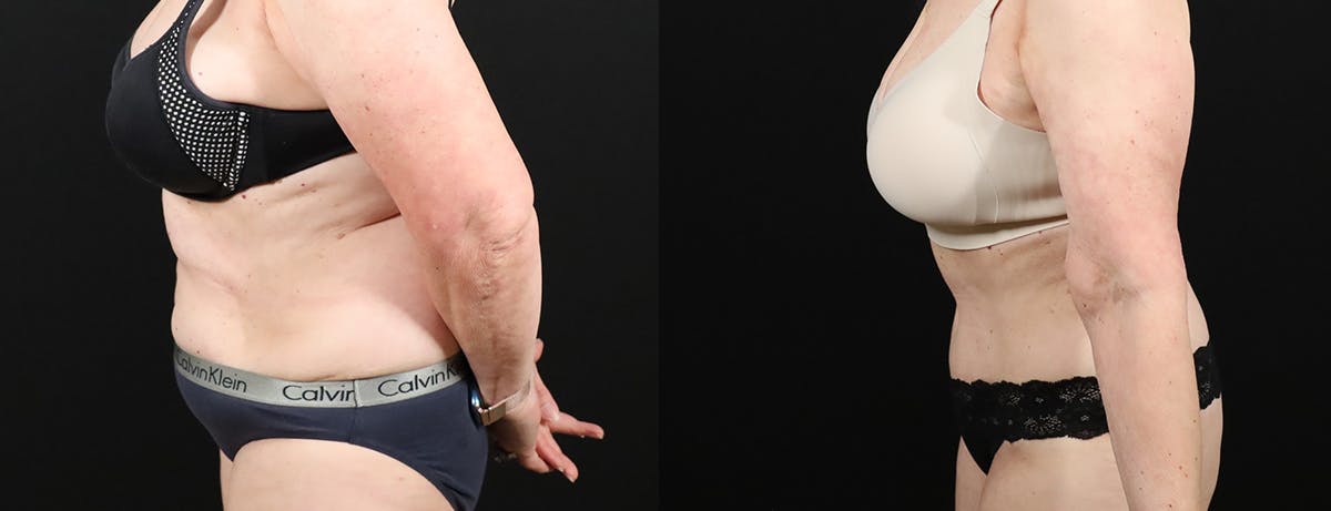 Abdominoplasty (Tummy Tuck) Before & After Gallery - Patient 217134 - Image 3