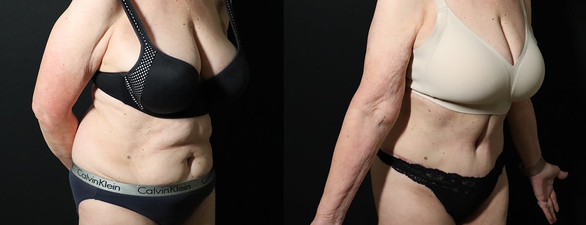 Abdominoplasty (Tummy Tuck) Before & After Gallery - Patient 217134 - Image 5