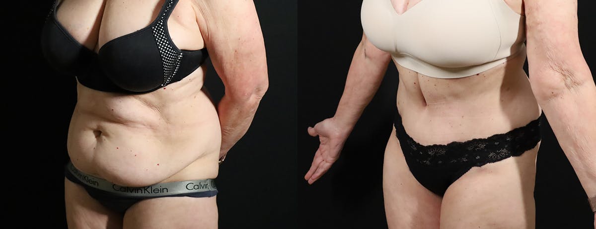 Abdominoplasty (Tummy Tuck) Before & After Gallery - Patient 217134 - Image 2
