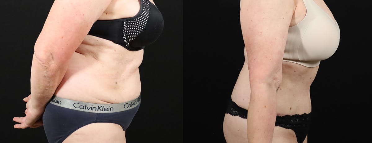 Abdominoplasty (Tummy Tuck) Before & After Gallery - Patient 217134 - Image 4
