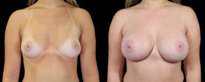 Breast Augmentation Before & After Gallery - Patient 529204 - Image 1