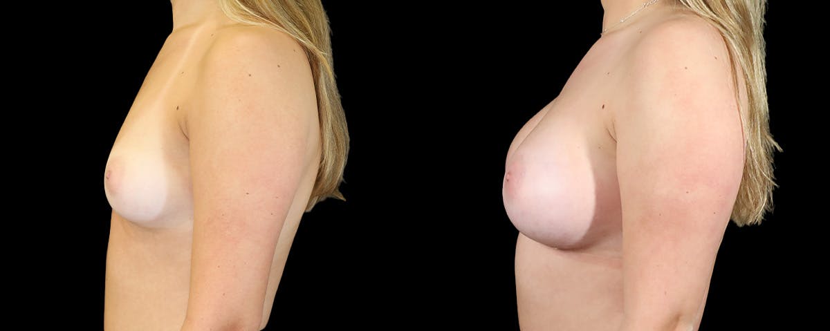Breast Augmentation  Before & After Gallery - Patient 529204 - Image 3