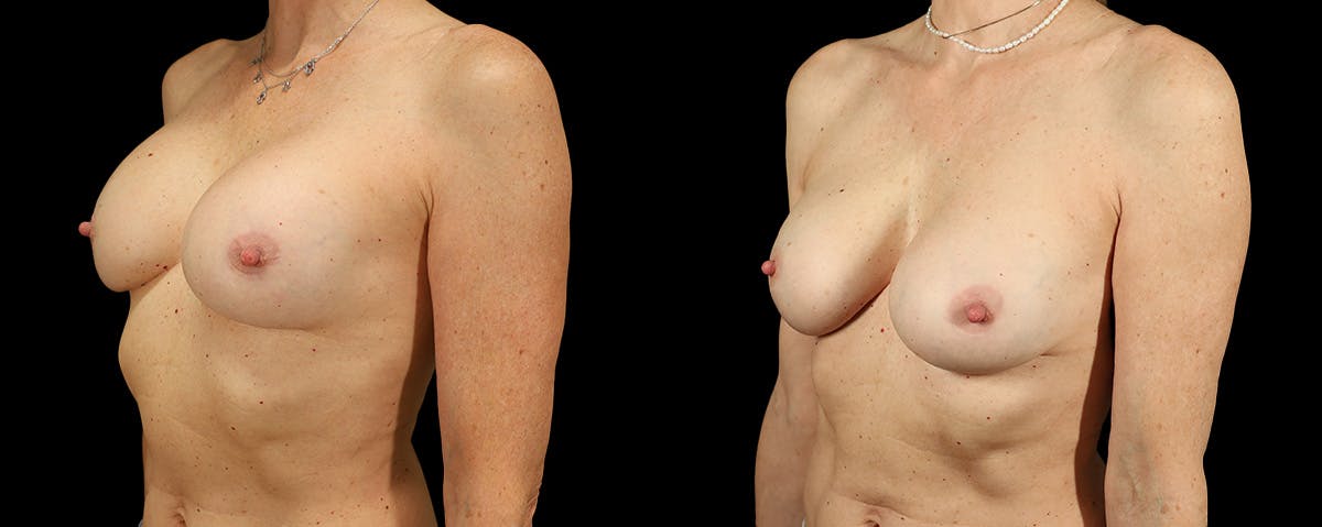 Breast Revision Before & After Gallery - Patient 256496 - Image 2