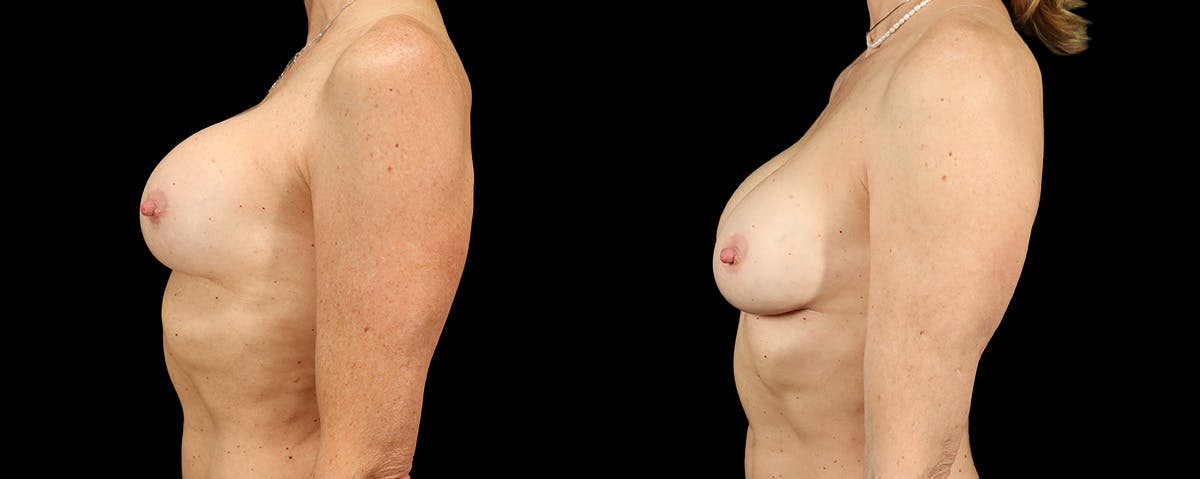 Breast Revision Before & After Gallery - Patient 256496 - Image 3