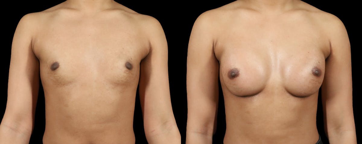 Breast Augmentation  Before & After Gallery - Patient 341729 - Image 1