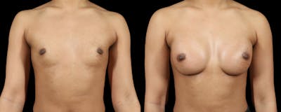 Breast Augmentation Before & After Gallery - Patient 341729 - Image 1