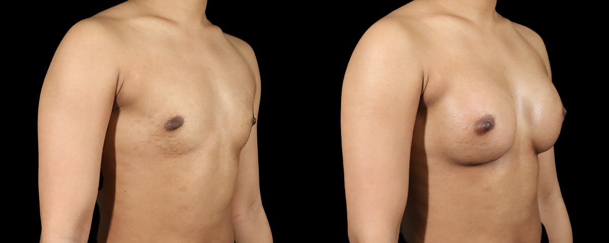 Breast Augmentation  Before & After Gallery - Patient 341729 - Image 2