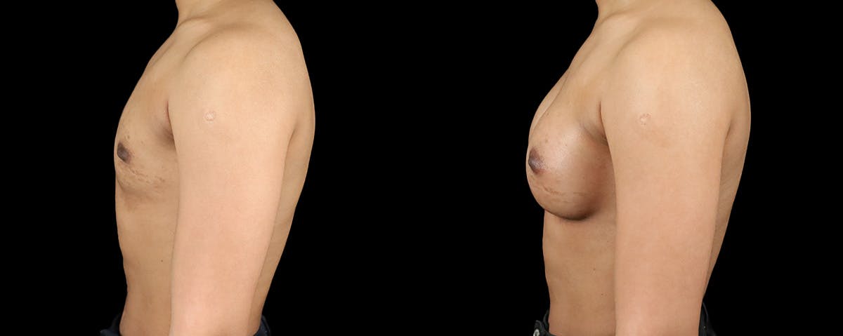 Breast Augmentation  Before & After Gallery - Patient 341729 - Image 3