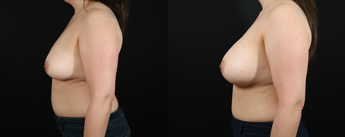 Breast Augmentation  Before & After Gallery - Patient 529178 - Image 3