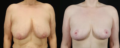 Breast Lift with Implants Before & After Gallery - Patient 629826 - Image 1