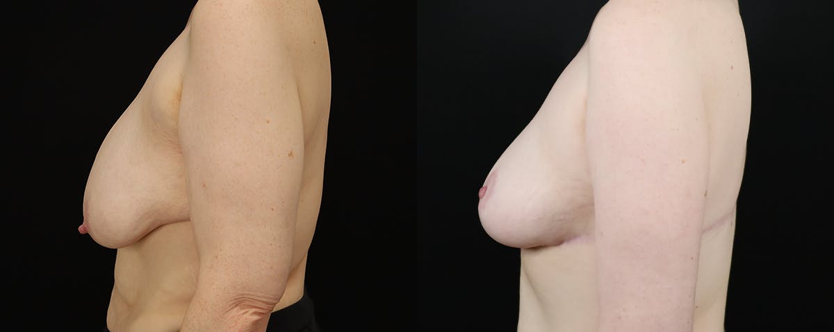 Breast Lift with Implants Before & After Gallery - Patient 629826 - Image 2