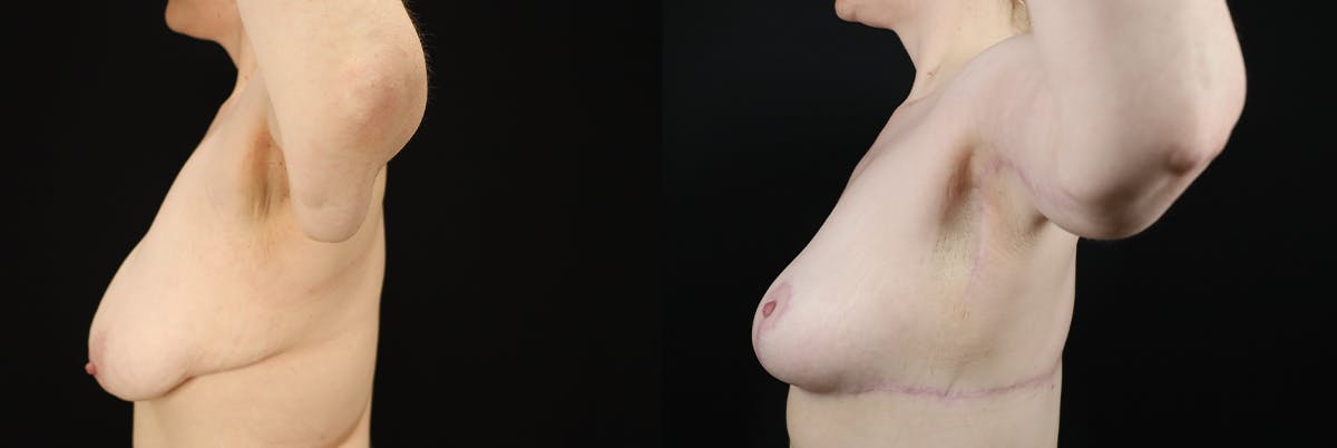 Arm Lift (Brachioplasty) Before & After Gallery - Patient 533021 - Image 2