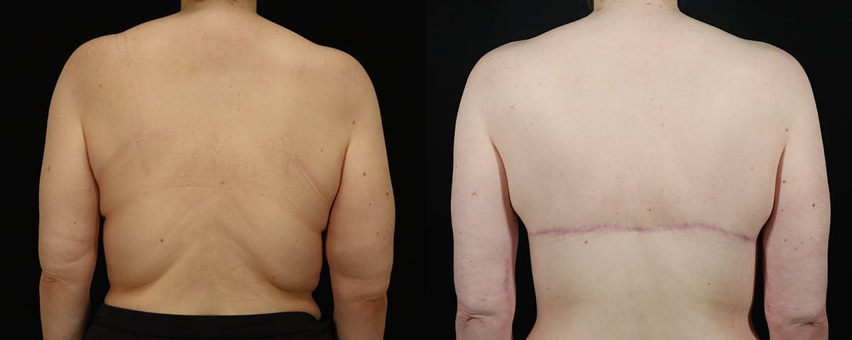 Bra-Line Back Lift Before & After Gallery - Patient 247542 - Image 1
