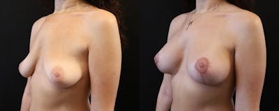 Breast Lift with Implants Before & After Gallery - Patient 592299 - Image 1