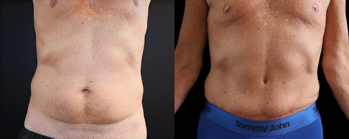 Male Abdominoplasty Before & After Gallery - Patient 230579 - Image 1
