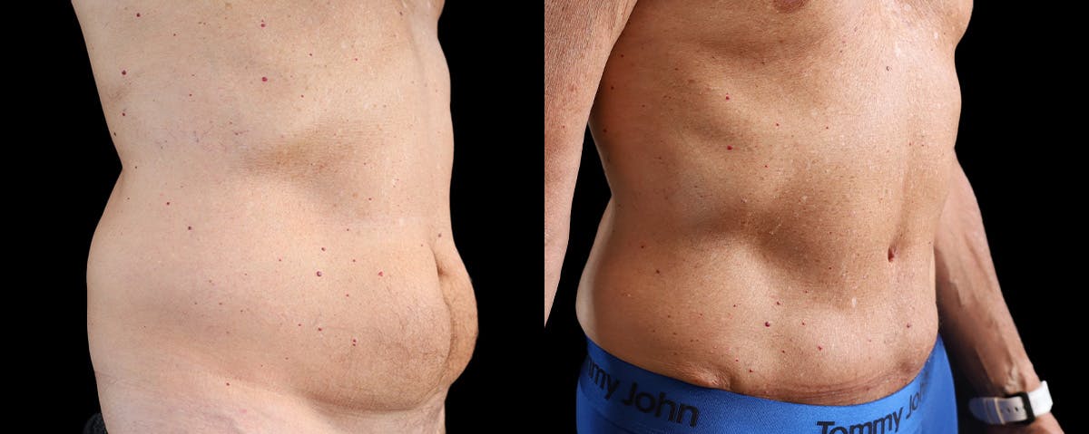 Male Abdominoplasty Before & After Gallery - Patient 230579 - Image 2