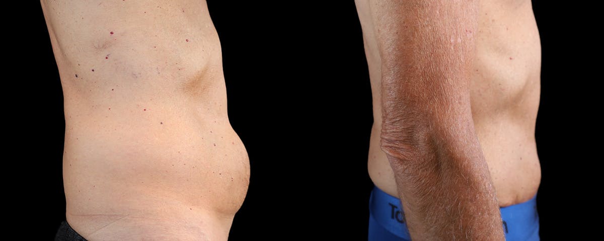 Male Abdominoplasty Before & After Gallery - Patient 230579 - Image 3