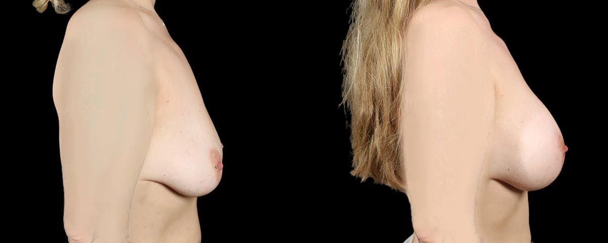 Breast Augmentation  Before & After Gallery - Patient 548332 - Image 3