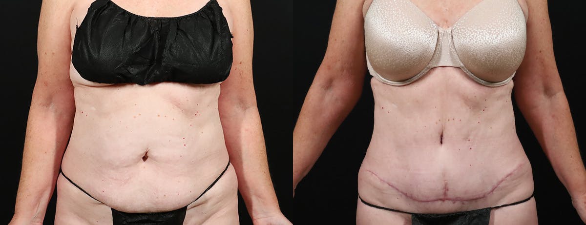 Abdominoplasty (Tummy Tuck) Before & After Gallery - Patient 134724 - Image 1