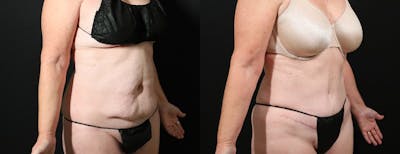Abdominoplasty (Tummy Tuck) Before & After Gallery - Patient 134724 - Image 2