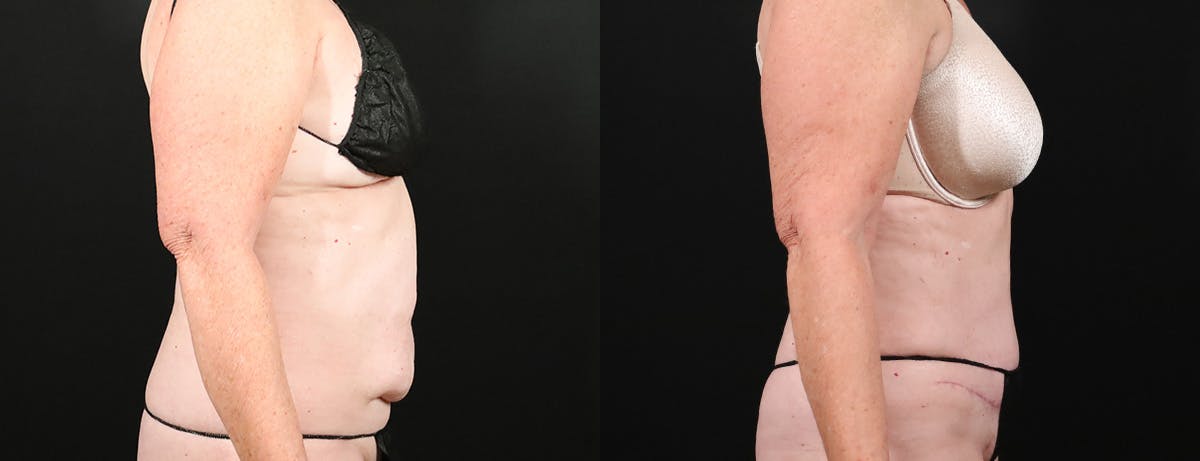 Abdominoplasty (Tummy Tuck) Before & After Gallery - Patient 134724 - Image 3