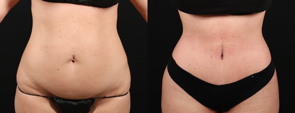 Liposuction Before & After Gallery - Patient 237807 - Image 1