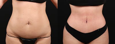 Liposuction Before & After Gallery - Patient 237807 - Image 1