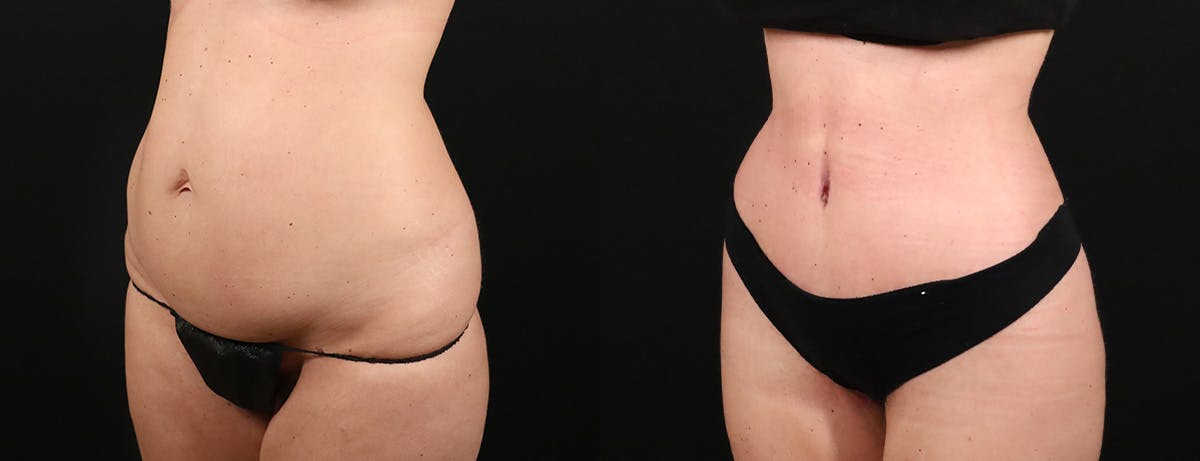 Liposuction Before & After Gallery - Patient 237807 - Image 2