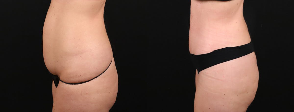 Liposuction Before & After Gallery - Patient 237807 - Image 3