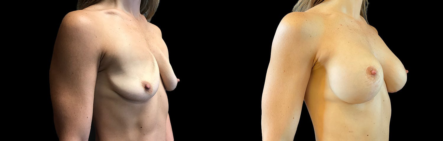 Breast Implant Exchange Before & After Gallery - Patient 267570 - Image 2