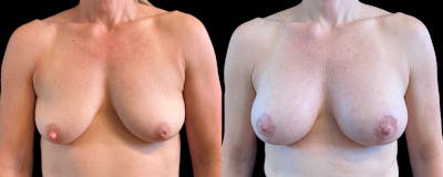 Breast Lift Before & After Gallery - Patient 352717 - Image 1