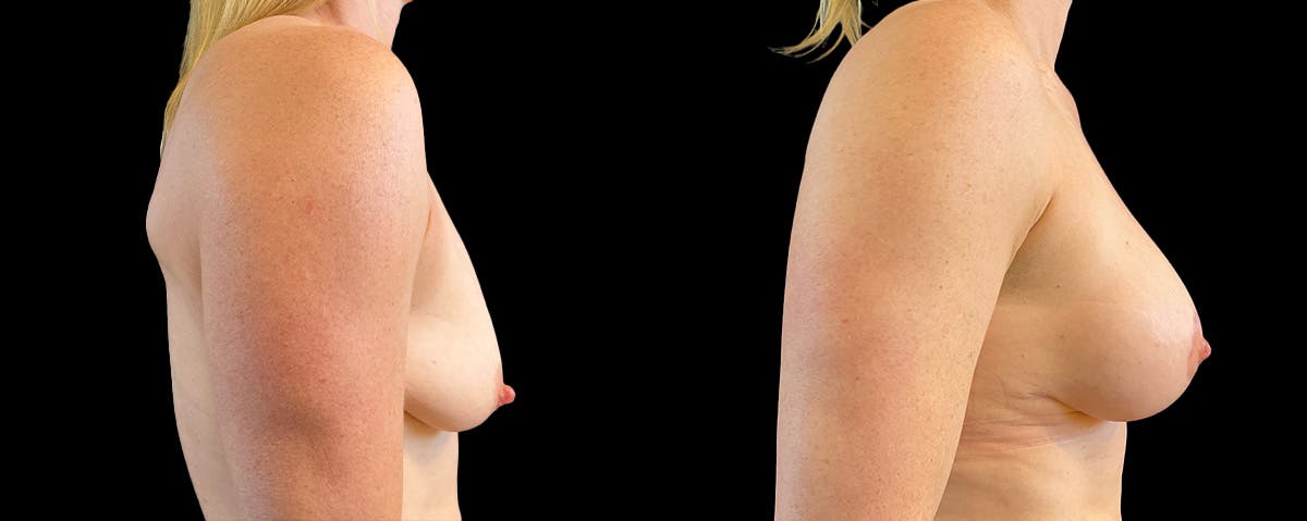 Breast Lift Before & After Gallery - Patient 352717 - Image 2