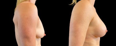 Breast Lift Before & After Gallery - Patient 352717 - Image 2