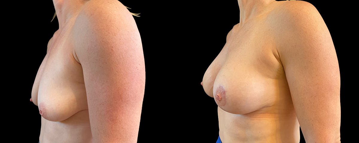 Breast Lift Before & After Gallery - Patient 352717 - Image 3