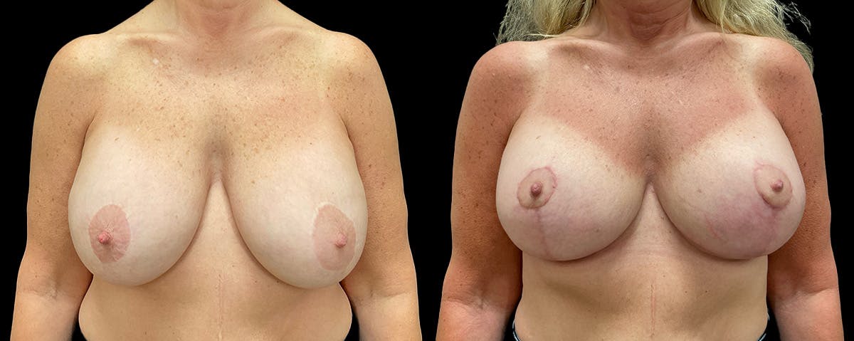 Breast Lift Before & After Gallery - Patient 178415 - Image 1