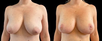 Breast Lift Before & After Gallery - Patient 406005 - Image 1