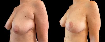 Breast Lift Before & After Gallery - Patient 406005 - Image 2