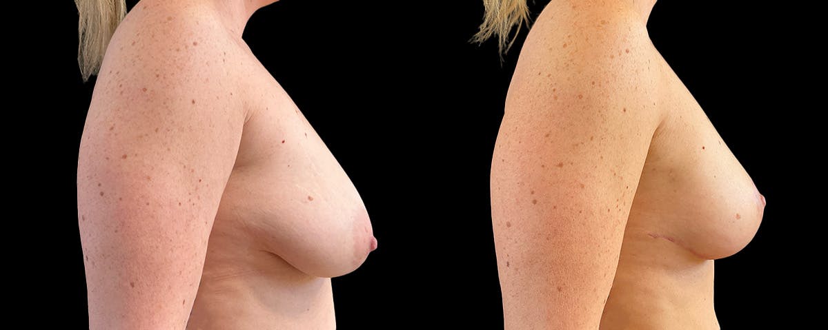 Mommy Makeover Before & After Gallery - Patient 214486 - Image 6