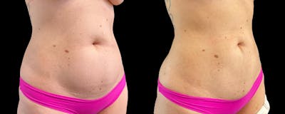 Liposuction and Fat Transfer Before & After Gallery - Patient 249312 - Image 2
