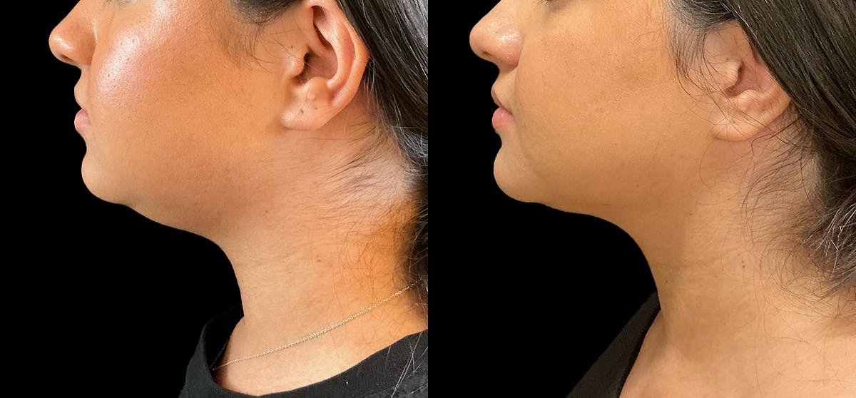 Liposuction Before & After Gallery - Patient 311618 - Image 1