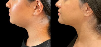 Liposuction Before & After Gallery - Patient 311618 - Image 1