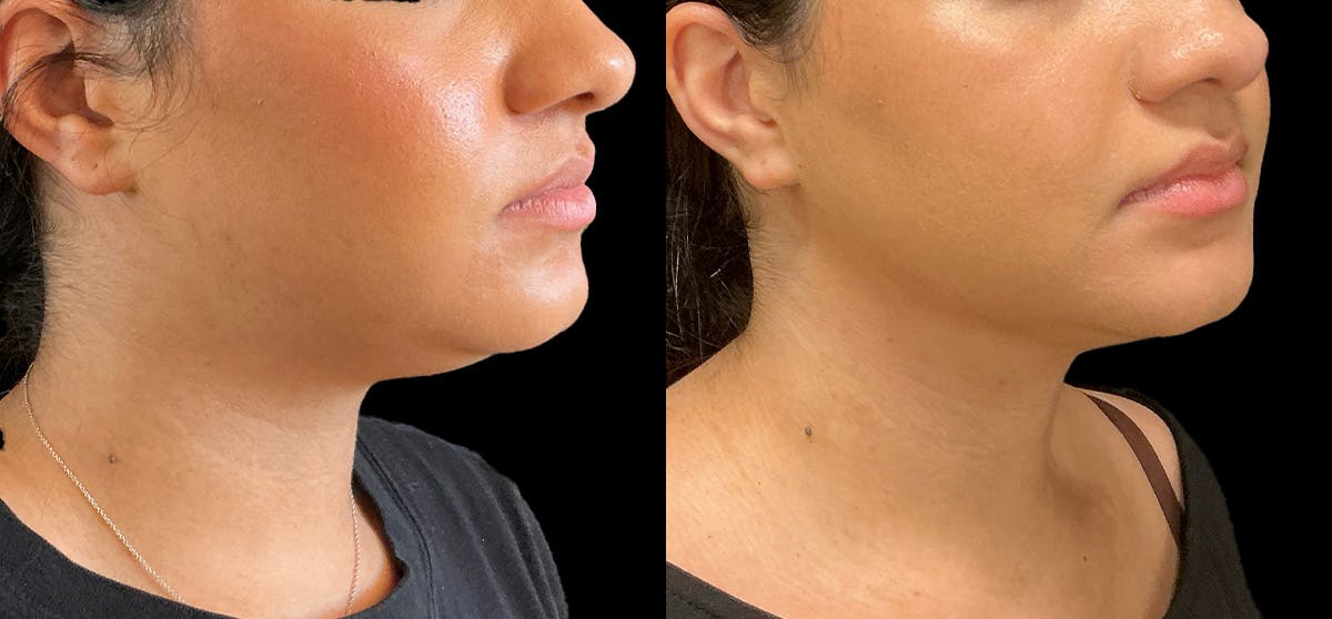 Liposuction Before & After Gallery - Patient 311618 - Image 2