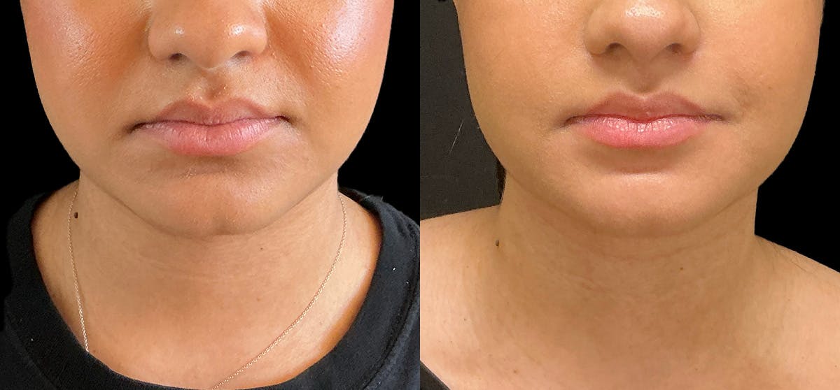 Liposuction Before & After Gallery - Patient 311618 - Image 3