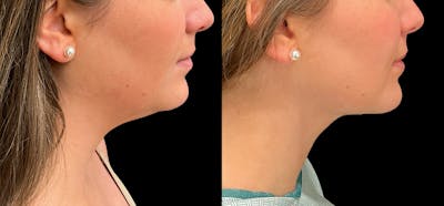 Liposuction Before & After Gallery - Patient 787627 - Image 1