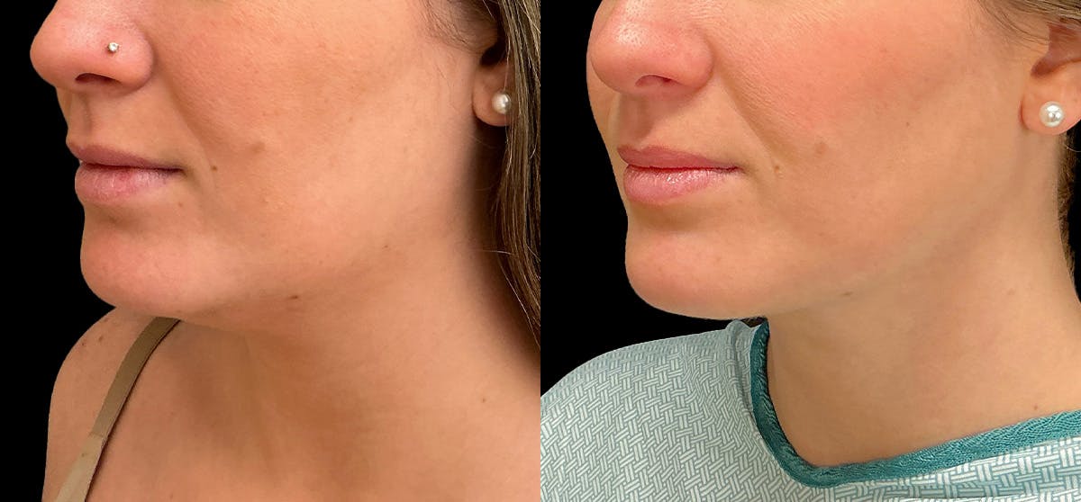 Liposuction Before & After Gallery - Patient 787627 - Image 2